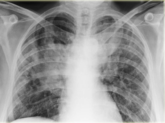 Chest Disease Classification